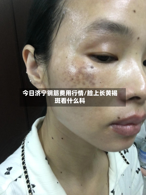 今日济宁钢筋费用行情/脸上长黄褐斑看什么科