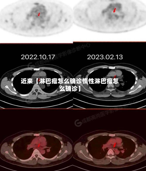 近来【淋巴瘤怎么确诊惰性淋巴瘤怎么确诊】